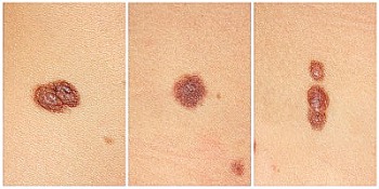 Skin Cancer Symptoms Moles