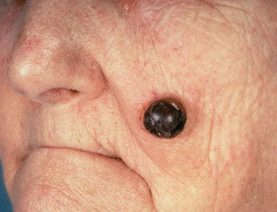 Skin Cancer Symptoms Moles