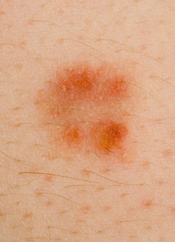 Skin Cancer Symptoms Photos