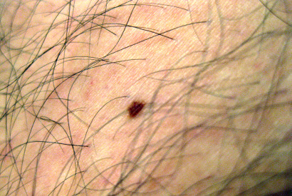 Skin Cancer Symptoms Photos