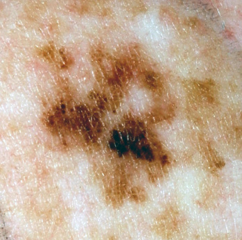 Skin Cancer Symptoms Photos