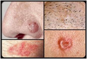 Skin Cancer Symptoms Pictures And Signs