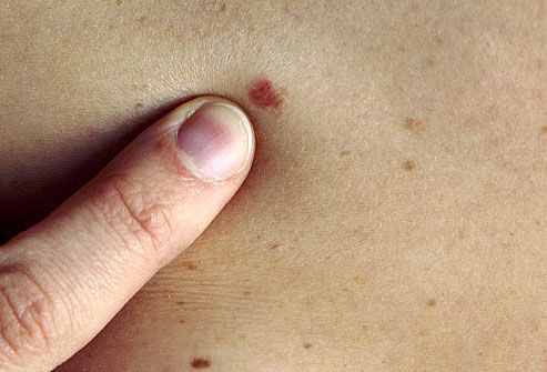 Skin Cancer Symptoms Pictures And Signs