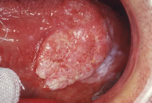 Tongue Cancer Symptoms Photos