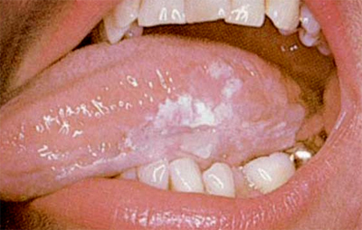 Tongue Cancer Symptoms Pictures