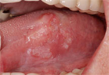 Tongue Cancer Symptoms Pictures