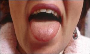 Tongue Cancer Symptoms Pictures